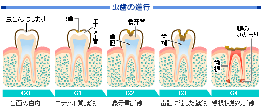 虫歯の進行