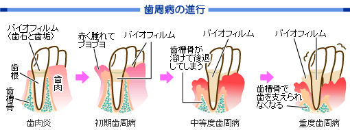 歯周病の進行